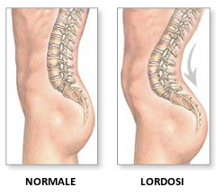Immagine rappresentante una colonna vertebrare con lordosi